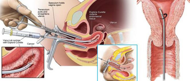 Endometrial biopsi