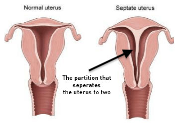 What is Uterine Septum?
