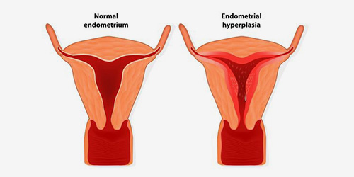 normal endometrium endometrial hyperplasia