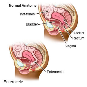 Normal ve enterosel anatomi karşılaştırması