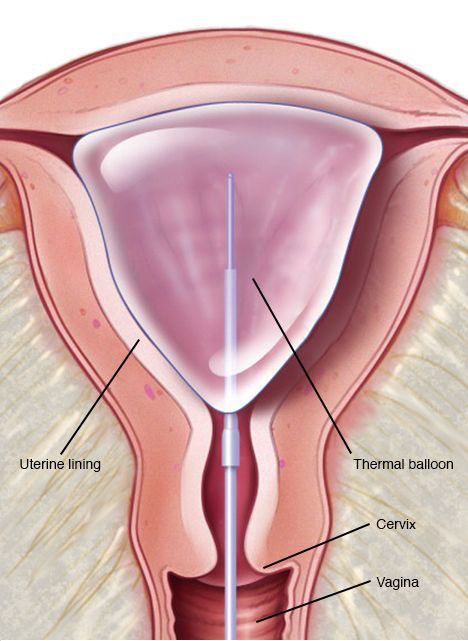 Endometrial Ablasyon