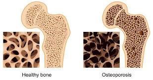 Osteoporoz (Kemik Erimesi)