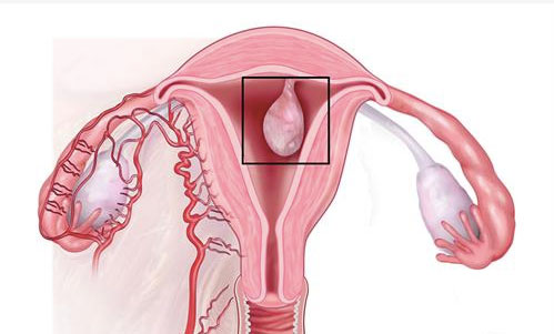 Rahim içi polipler (Endometrial Polip)