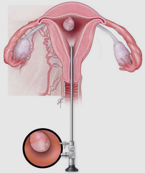 Rahim içi polipler (Endometrial Polip)