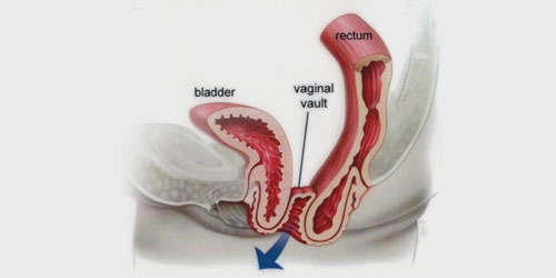 Vajina Sarkması - Vajinal Cerrahi