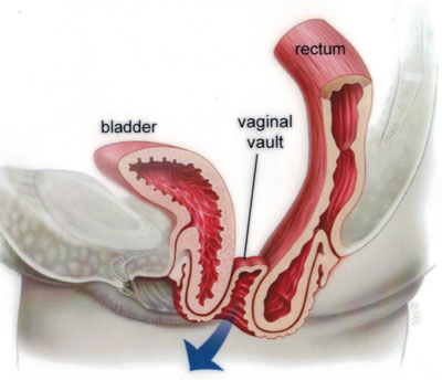 Vajina Sarkması - Vajinal Cerrahi