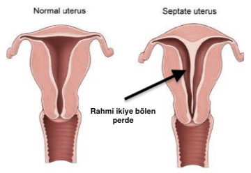 uterin septum