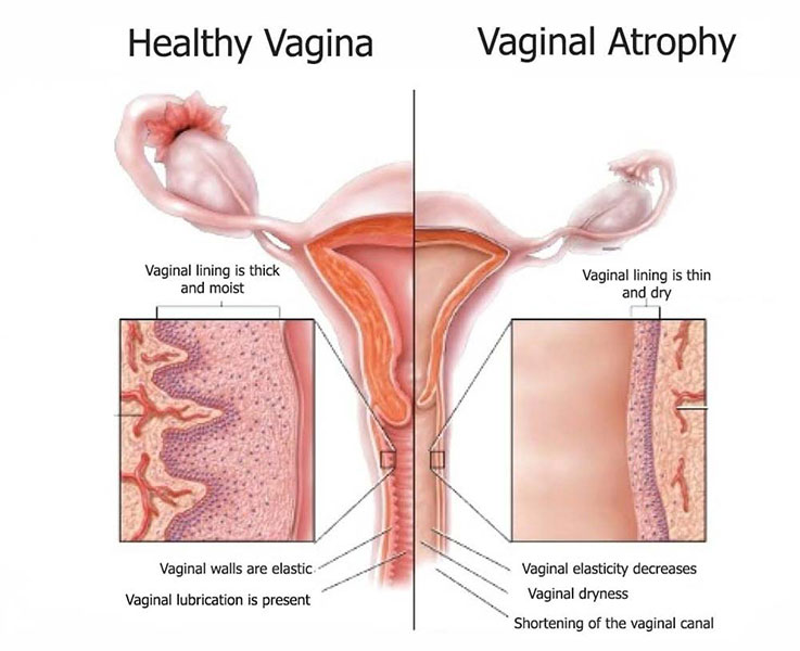 Sağlıklı vajina ve atrofi durumunun anatomik karşılaştırması.